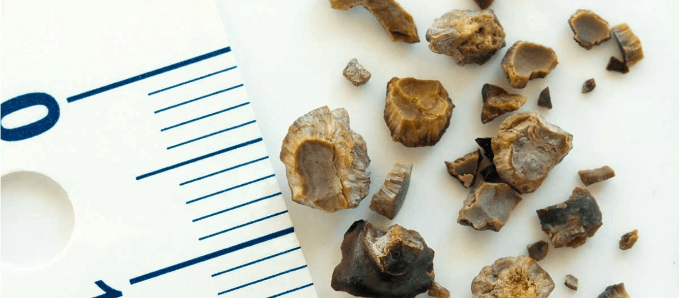 Kidney Stones- What You Need to Know